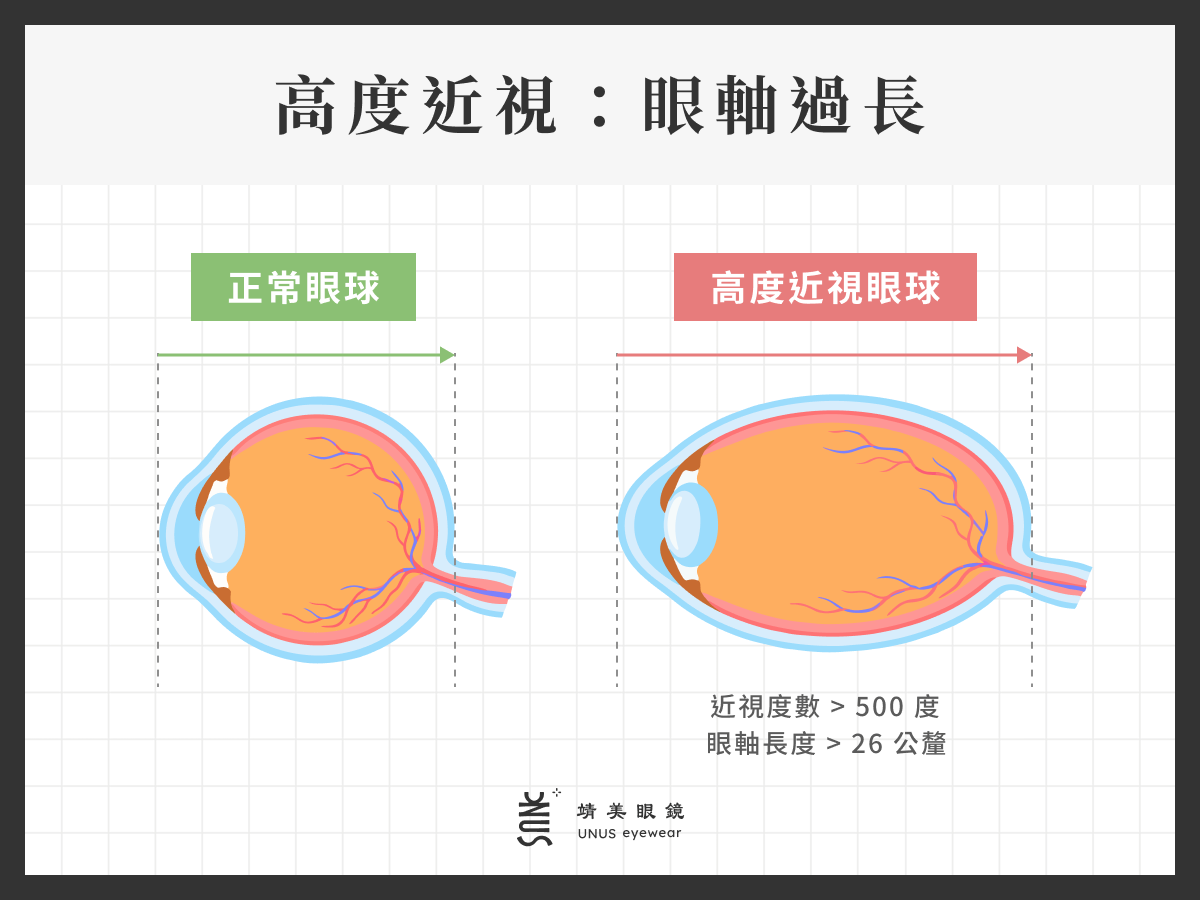 高度近視示意圖