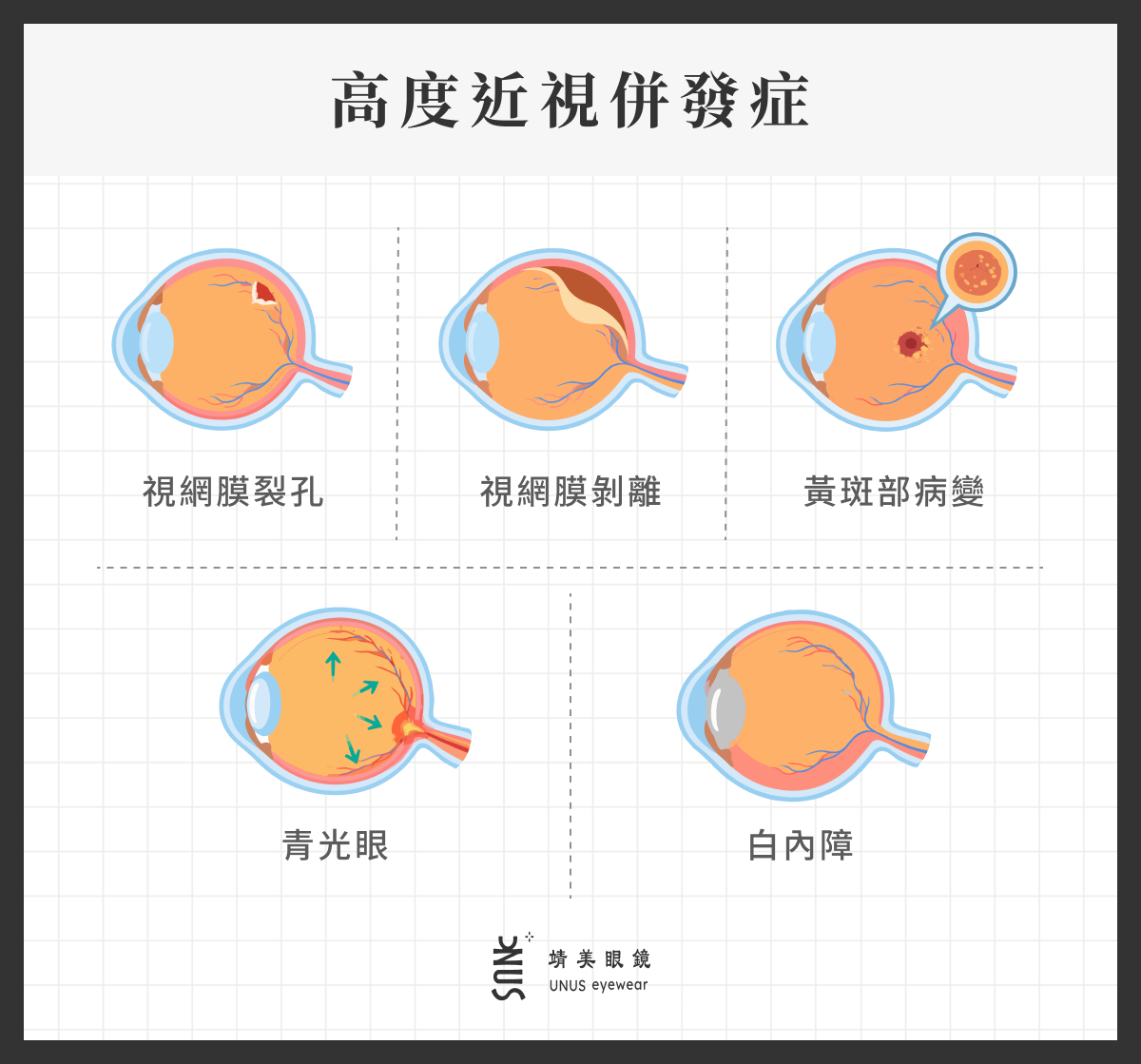 高度近視併發症